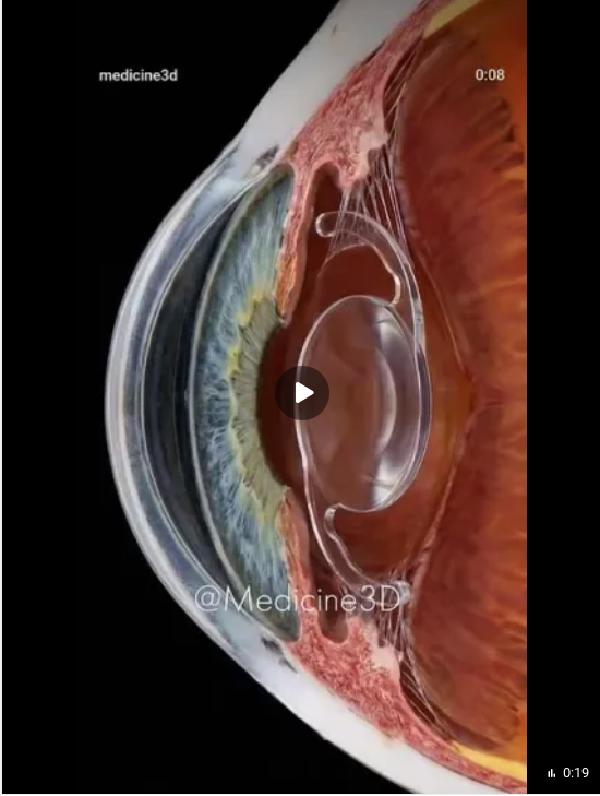 Искусственный интеллект с применением 3d моделирования за 20 секунд показал, как мутнеет хрусталик в глазу человека. Искусственный интеллект с применением 3d моделирования за 20 секунд показал, как мутнеет хрусталик в глазу человека.